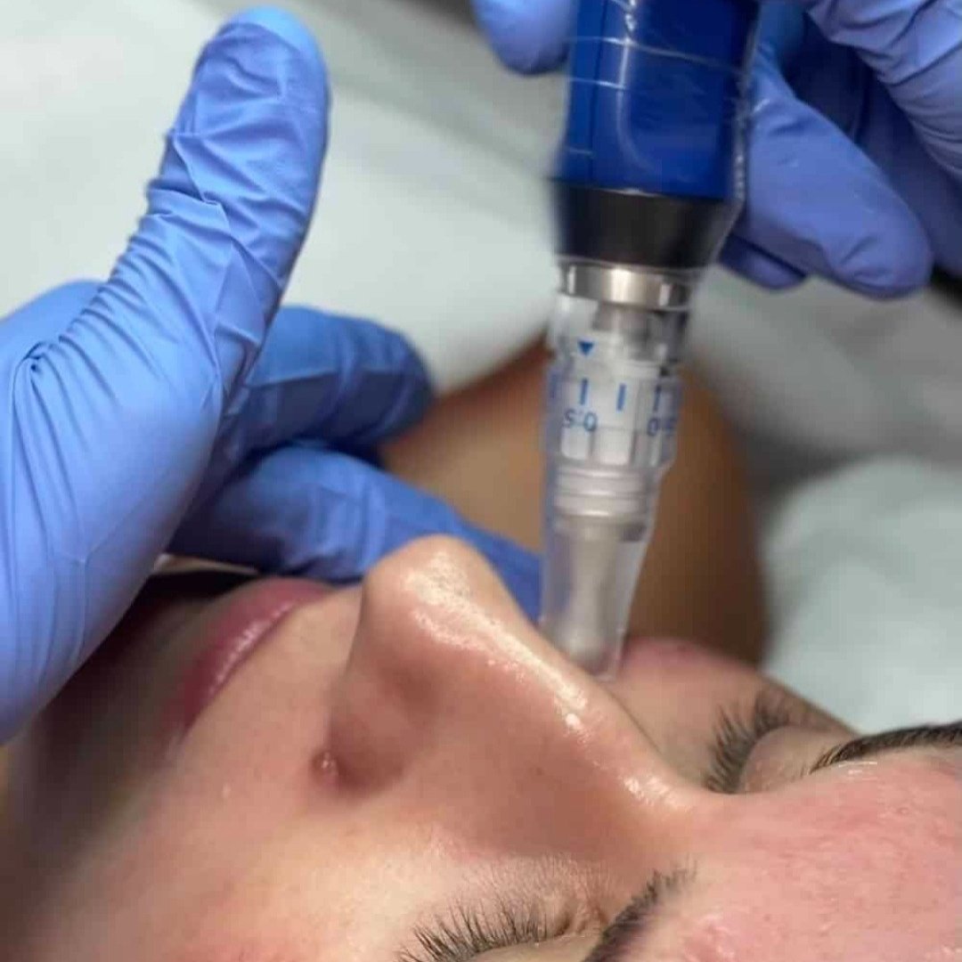 Skin Pen Micro-needling